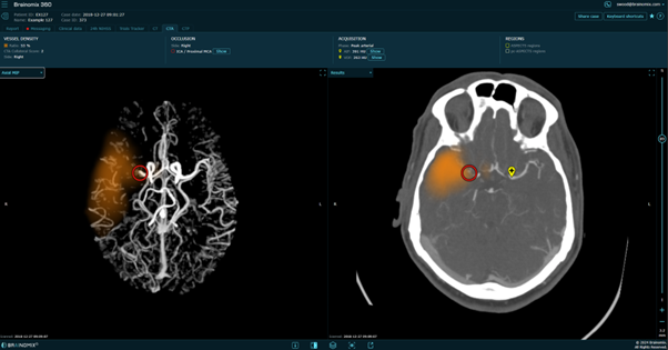 A scan of a brain